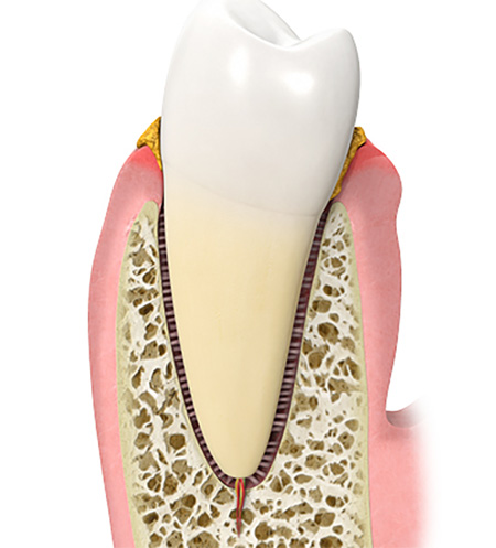 Gingivitis